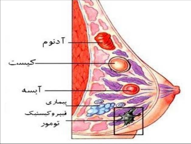 راهنمای خودمراقبتی بیمارسهای خوش خیم پستان