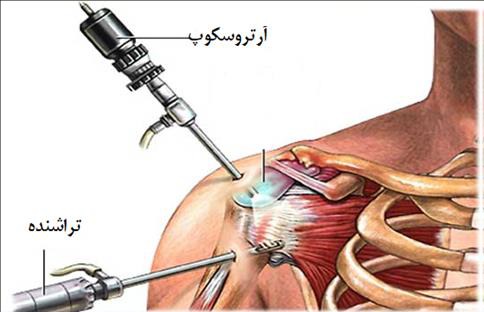 راهنمای خودمراقبتی بیماران آرتروسکوپی شانه (درمان دررفتگی مکرر)