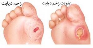 راهنمای خودمراقبتی بیماران پای دیابتی