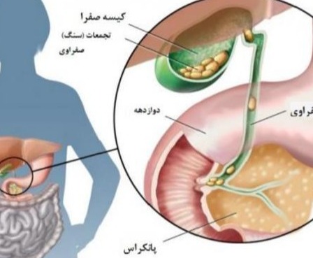 راهنمای خودمراقبتی بیماران کله سیستکتومی