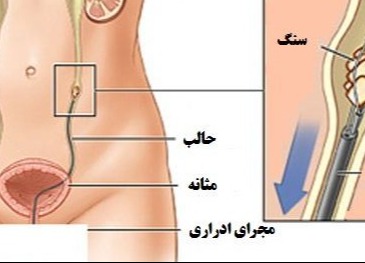 راهنمای خودمراقبتی بیماران TUL (سنگ شکنی درون اندامی)