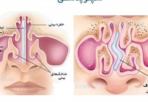 راهنمای خودمراقبتی بیماران جراحی سپتوپلاستی