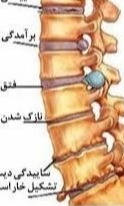 راهنمای خودمراقبتی بیماران جراحی دیسک کمر