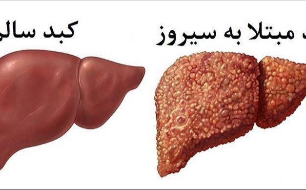 راهنمای خودمراقبتی بیماران سیروز کبدی