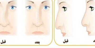 راهنمای خودمراقبتی بیماران جراحی رینوپلاستی