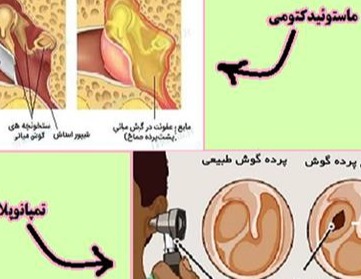 راهنمای خودمراقبتی بیماران تمپانوپلاستی / ماستوئیدکتومی