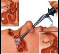 راهنمای خودمراقبتی جراحی آندوسکوپی سینوس