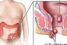 راهنمای خودمراقبتی بیماران هموروئیدکتومی
