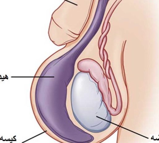 راهنمای خودمراقبتی بیماران هیدروسل