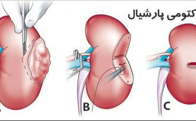 راهنمای خودمراقبتی بیماران نفرکتومی