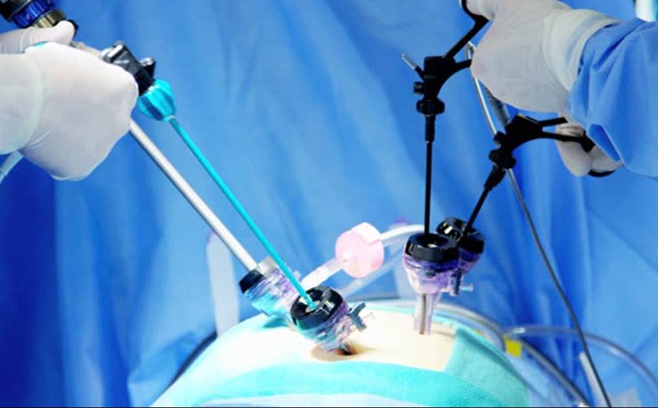 لاپاراسکوپی