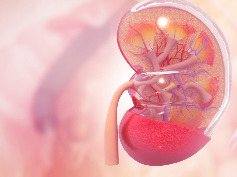 سندرم نفروتیک