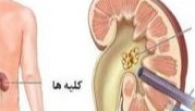 راهنمای خودمراقبتی بیماران  PCNL (خارج کردن سنگ کلیه از راه پوست)