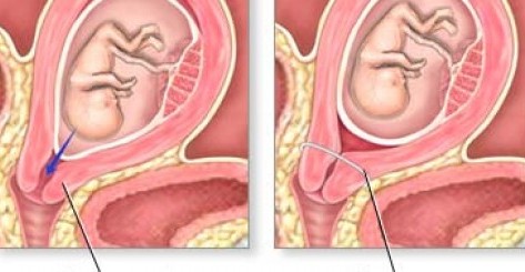 اختلالات نوك پستان در زایمان و حاملگی